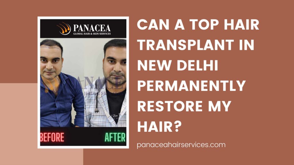 Top Hair Transplant in New Delhi